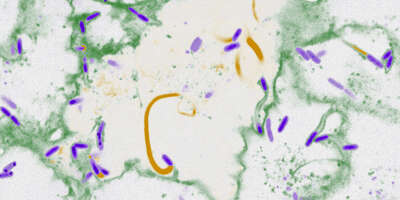The pathogen Burkholderia thailandensis (purple) uses cellular components (yellow) to form membrane protrusions from one host cell to another (green).